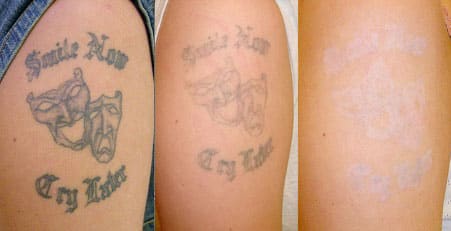 tattoo-removal-before-and-after-15.jpg
